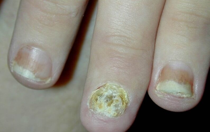 hand nails psoriasis