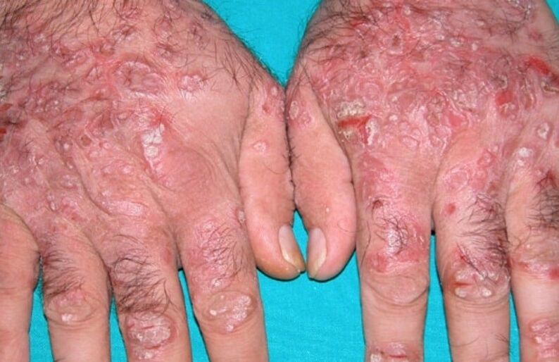 tearful psoriasis on hands