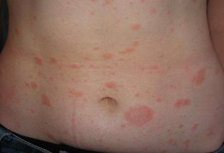 How to treat psoriasis of the body