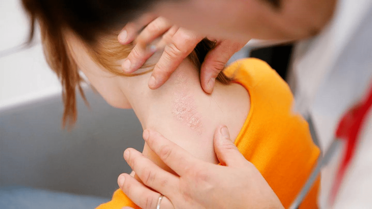 How psoriasis looks on the body