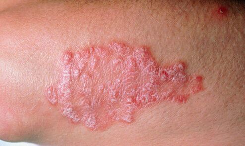 psoriasis on the skin picture 2