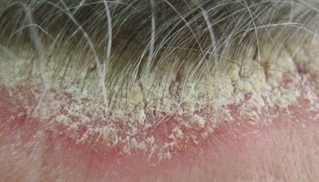 picture of psoriasis on the head 5