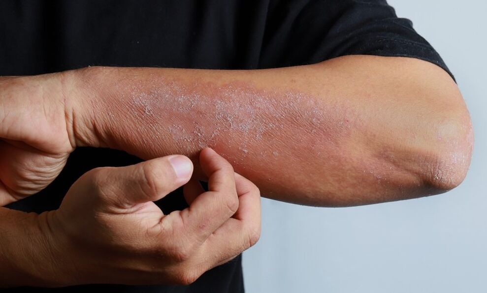 signs of psoriasis on the arm