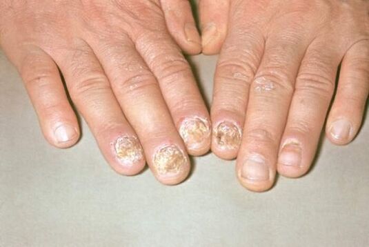 psoriasis nail image 1