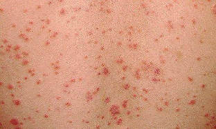how is psoriasis early stages