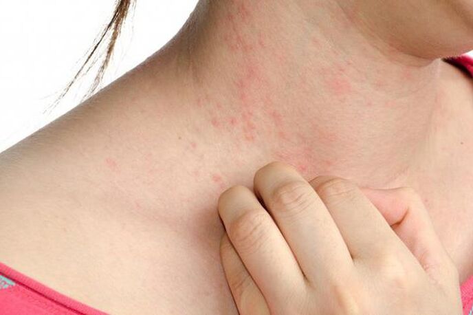 Exacerbation of psoriasis is manifested by skin rash and severe itching