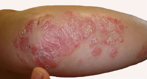 Scaly, voluminous plaques on the elbow during an exacerbation of psoriasis