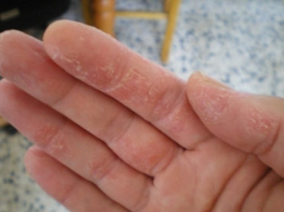 psoriasis hands