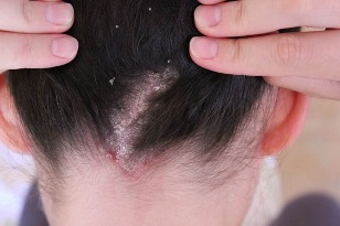 Psoriasis in the head