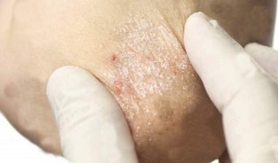 treatment of psoriasis in the weakening phase