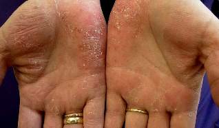 medication for psoriasis