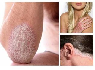 What is psoriasis and how to deal with it