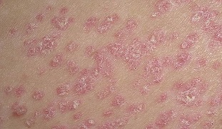 Early stages of psoriasis